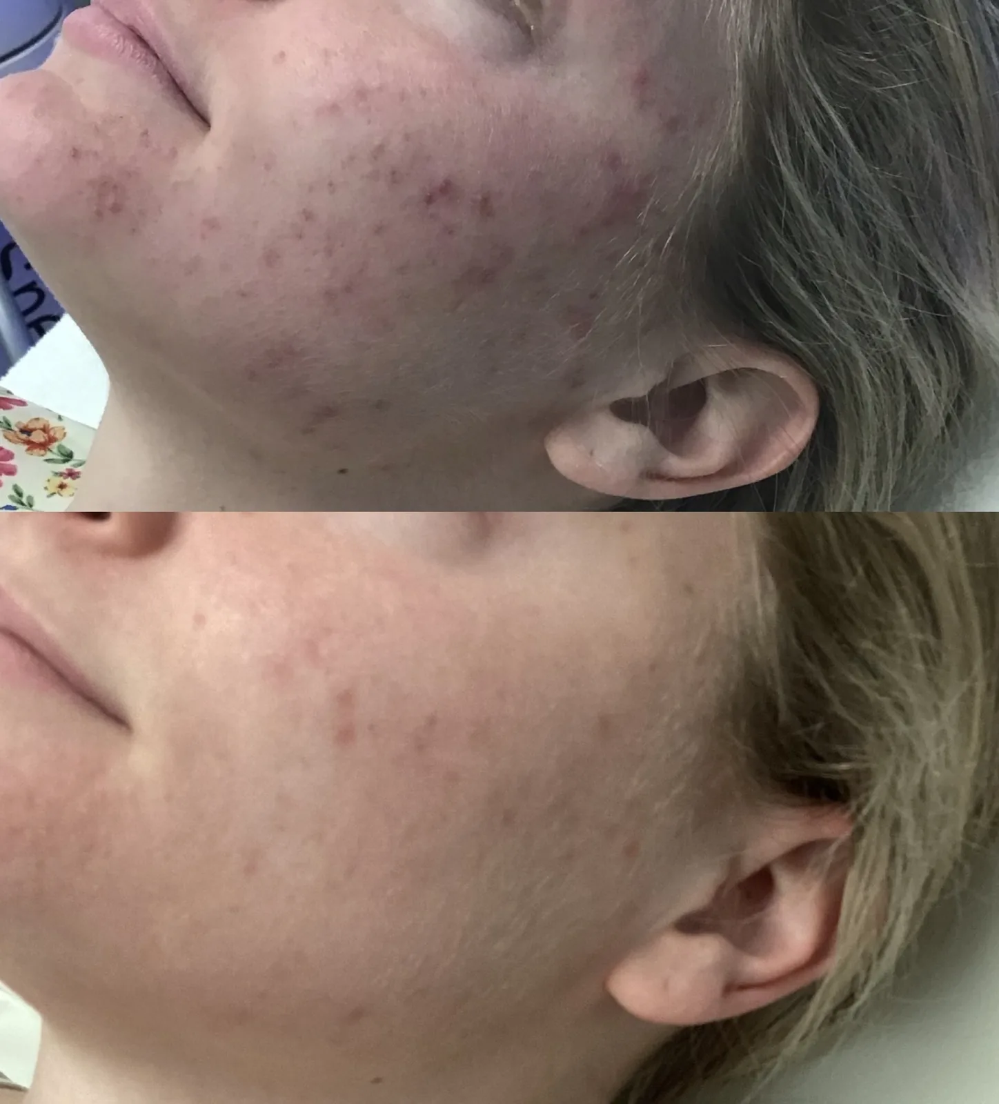 Before and after: IPL on the cheeks