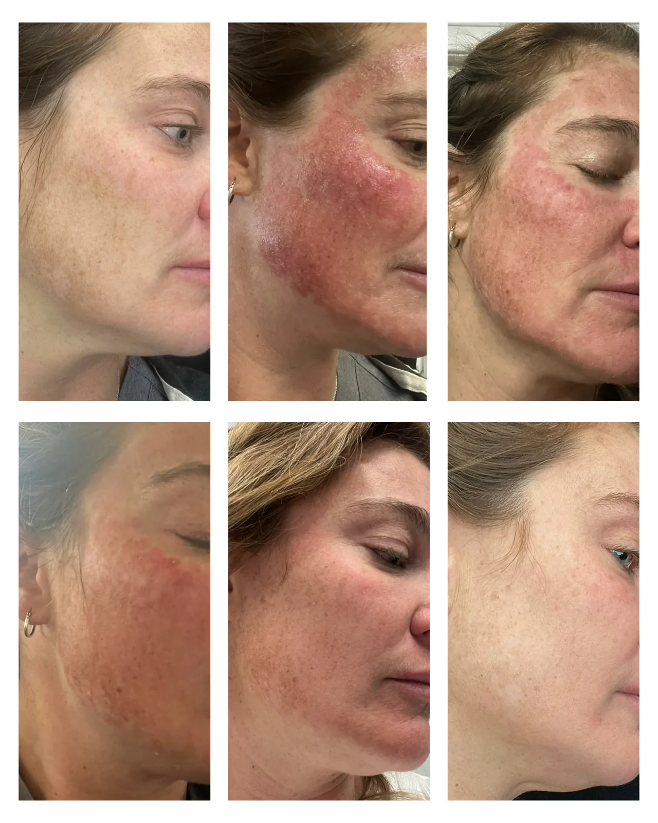 Before and after: skin resurfacing