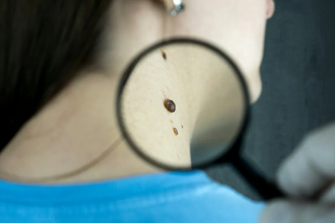 A mole on the neck examined under a magnifying glass